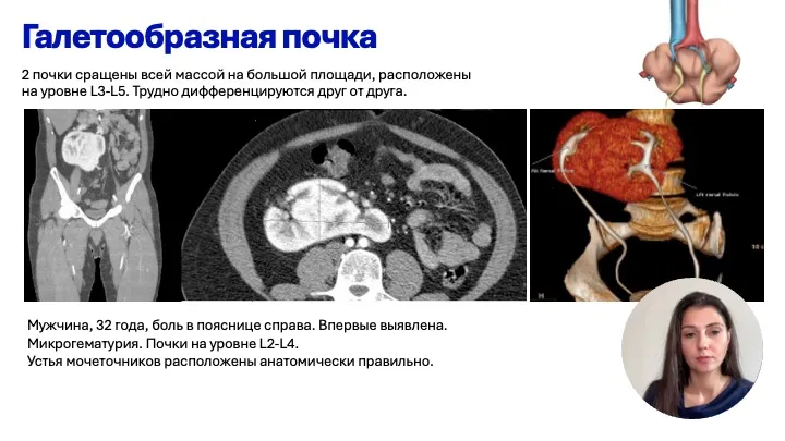 Пороки развития почек