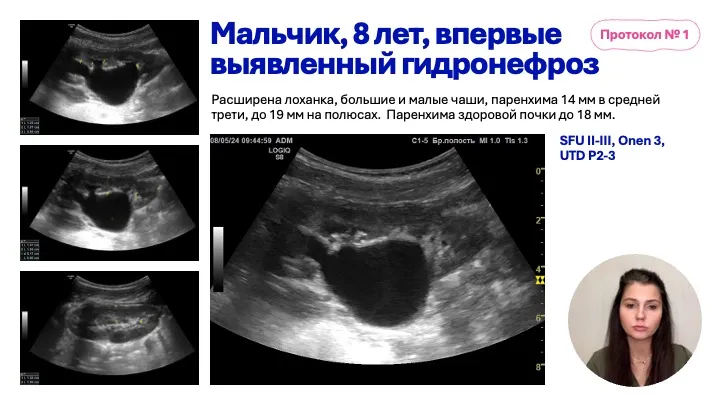 Обструктивные уропатии