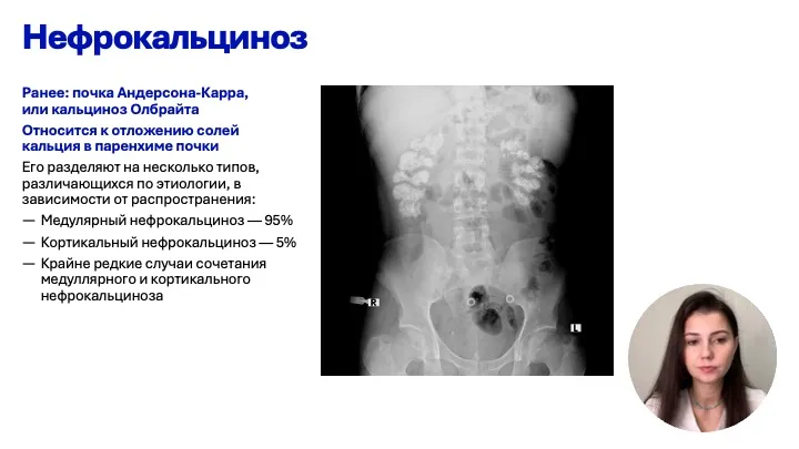Обменные нефропатии