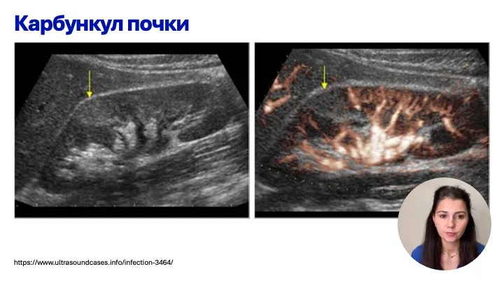 Воспалительные заболевания мочевыводящих путей